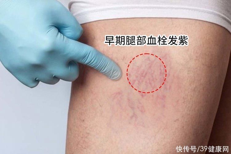 血栓来临手脚先知的四个症状(血栓来临，手脚先知！提醒：手脚出现4种表现，或提示你血管堵了)