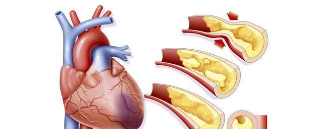 冠心病|冠心病患者有福了,在心脏上架起“桥梁”,能让生命重获“心”生