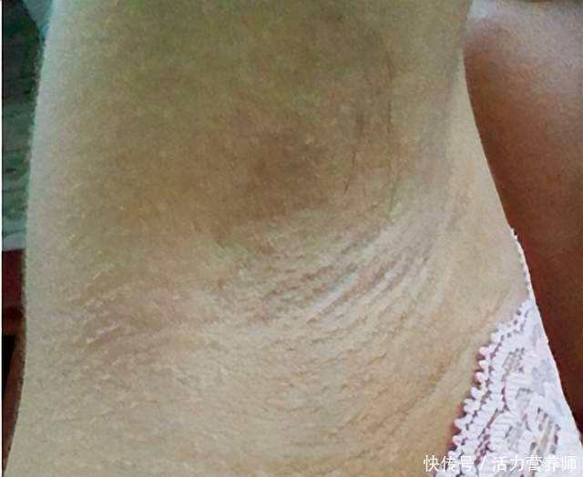 油耳型腋臭如何有效治疗(腋臭的人，往往也会伴随着“油耳”？两者到底什么关系？告诉你)