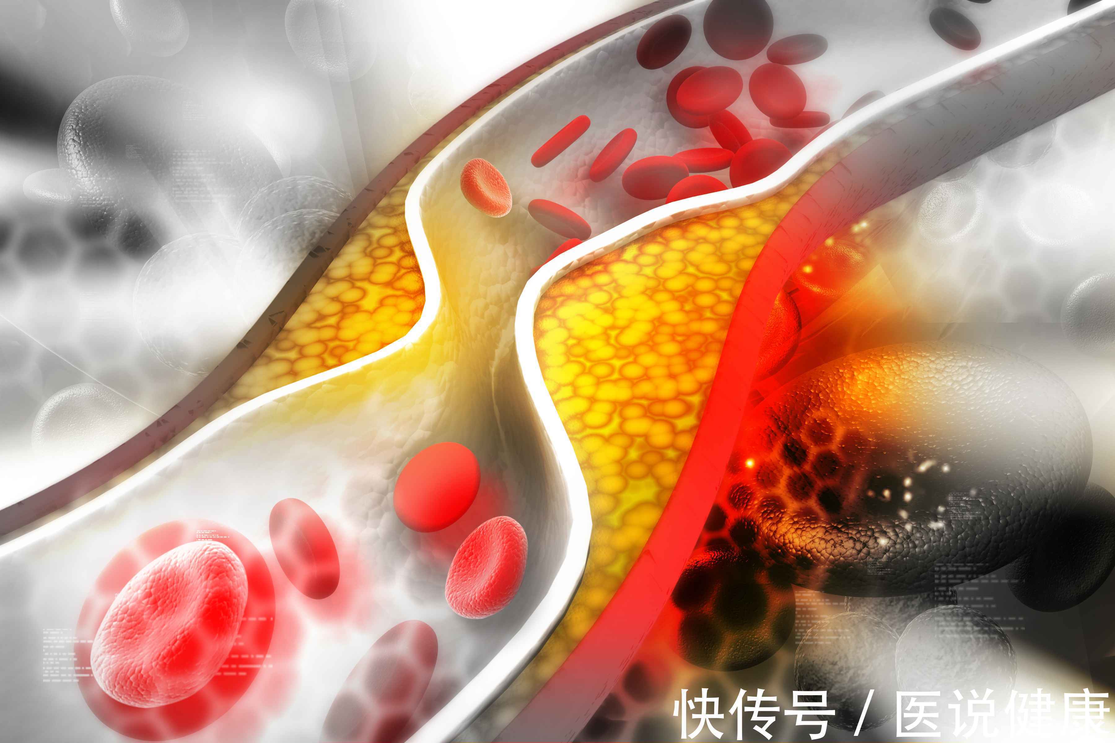 心脏病发展到什么情况最危险(心脏发病率越来越高，或与这5种情况有关，需了解清楚)