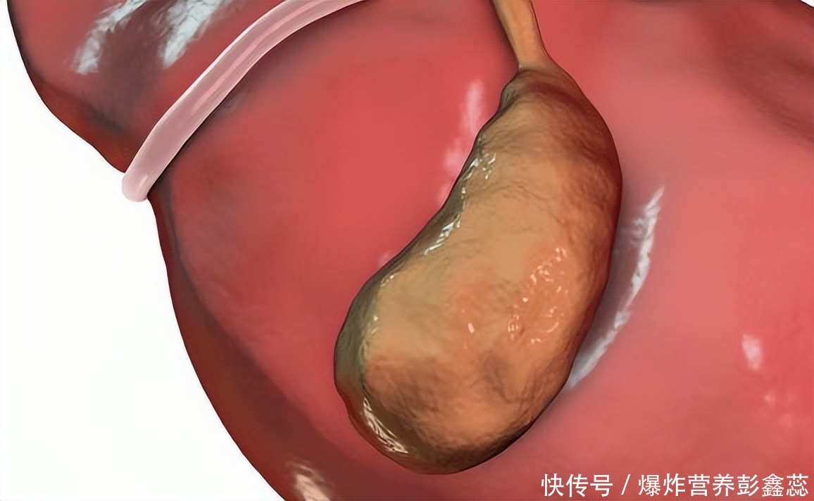四种人胆囊息肉要警惕了(提示：有胆囊息肉的人，要记住这4件事，帮你让息肉越来越小)