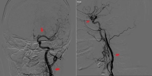  半身不遂|31岁年轻妈妈突发半身不遂 医生还原可怕的家庭真相