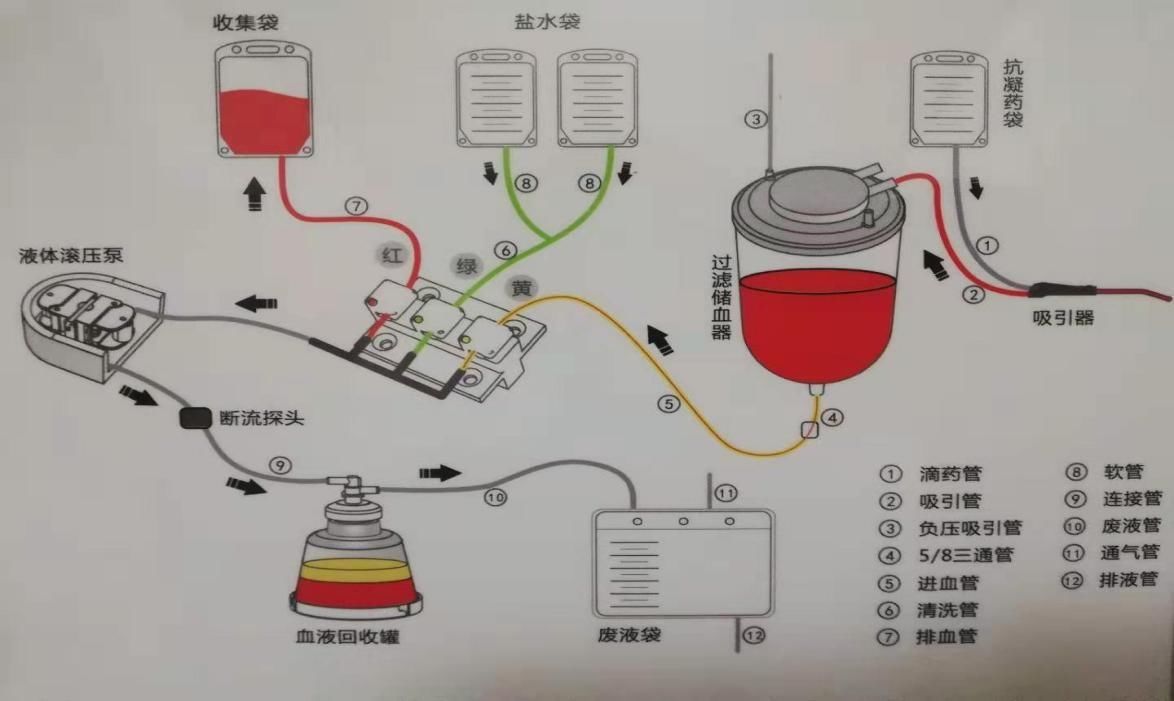 回收式自体输血(一文了解“回收式自体输血”)