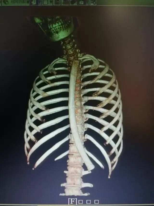 异物|杭州一女子胃内惊现14cm大勺子!原因竟是……