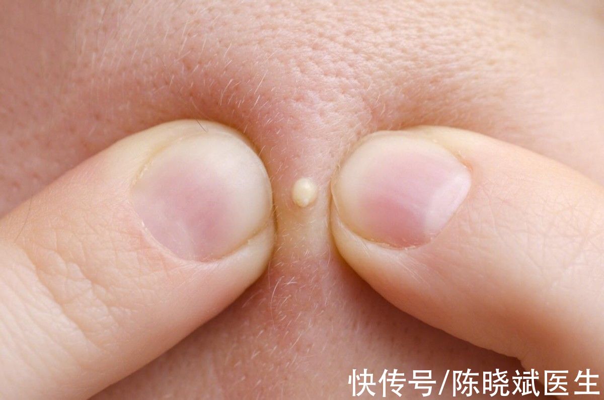 祛痘机构痘痘能彻底治好吗(痘痘反反复复消不下去怎么办？悟空祛痘这类祛痘机构好不好？)