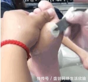  女子|女子3年没洗脚，出嫁前父母带去修脚，刮下来的死皮竟有1厘米厚