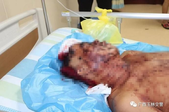  交通事故|紧急！男子不戴安全帽酿事故致颅骨开裂 所幸“警医联动”救其一命 | 一盔一带