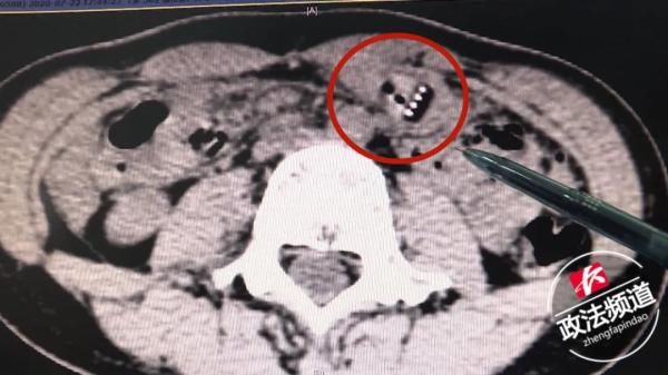  异物|女生边刷牙边看综艺节目，一阵狂笑后把牙刷吞了下去...