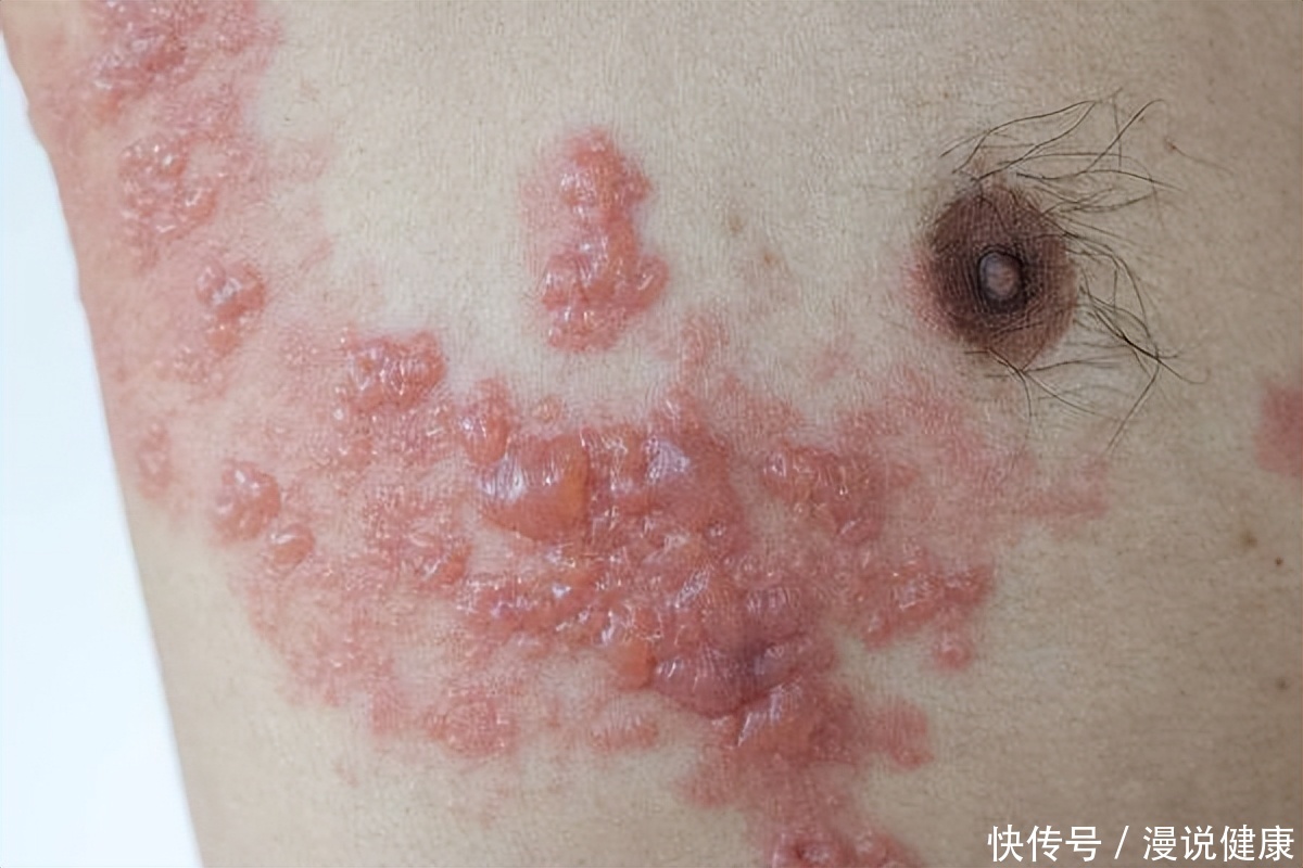 皮肤上长的湿疹是怎么引起的(皮肤长湿疹？身上的这4个迹象，警惕你小心患上这种“不死之癌”)