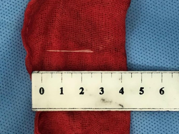 异物|杭州一女子胃内惊现14cm大勺子!原因竟是……