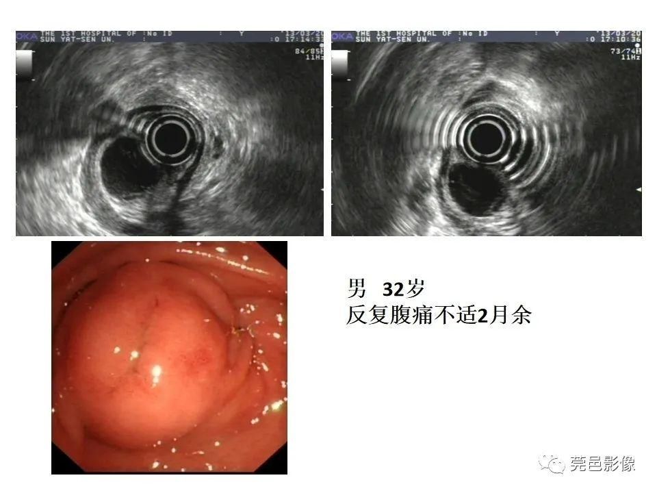 畸形|胃重复畸形CT诊断与鉴别诊断
