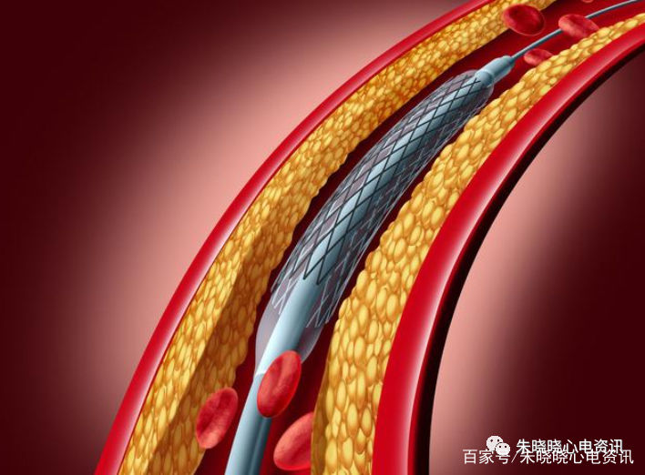 冠状动脉|左主干闭塞的心电图表现