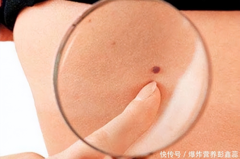 长在这几个地方的黑色痣，或是身体异常的表现，不能再忽视了2023