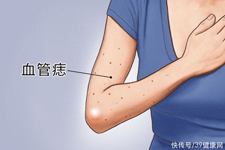 身上有红痣是肝病的前兆吗(身上长红痣，代表肝病来临？提醒：肝病变时，手脚可能有4种怪象)