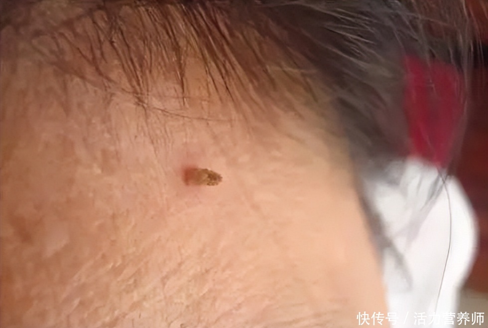 脖子上不痛不痒的小肉球是什么(脖子上有很多小肉球是什么，还不痛不痒？对人体有危害吗？)