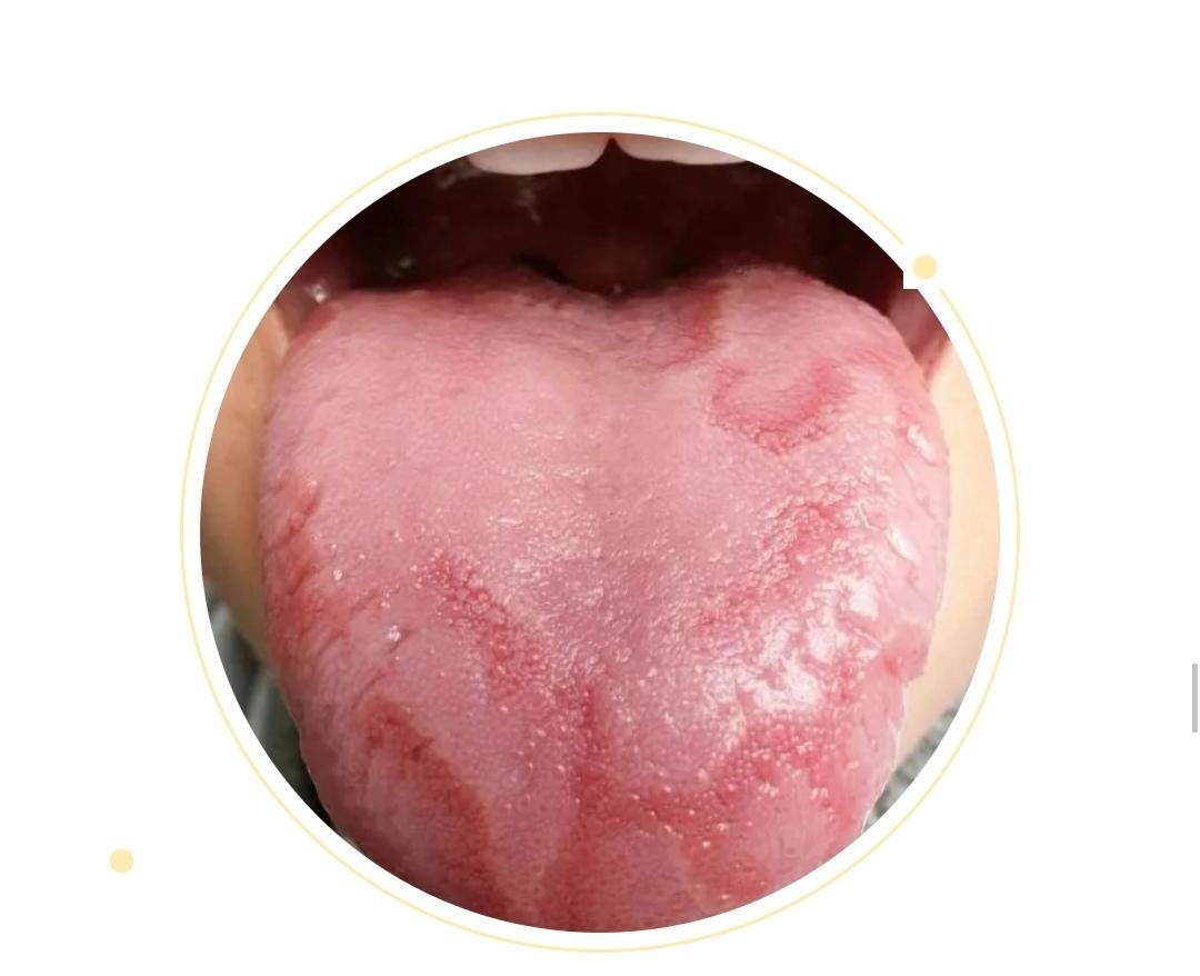  变化|身体健康情况怎么样？可以从舌头进行窥探