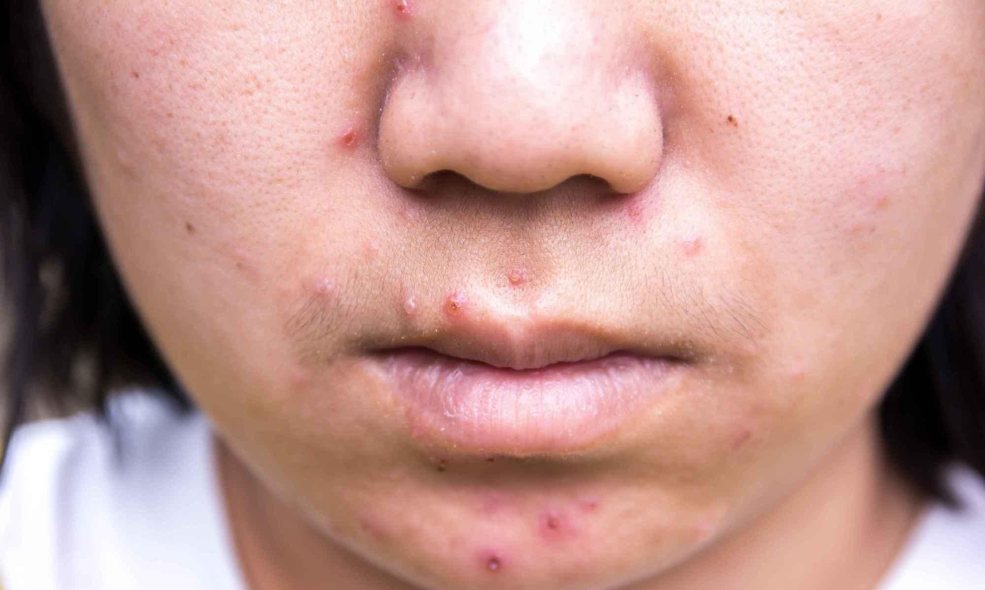  排毒|脸部会出现这2个表现，肝脏可能需要排毒，现在知道也不晚！