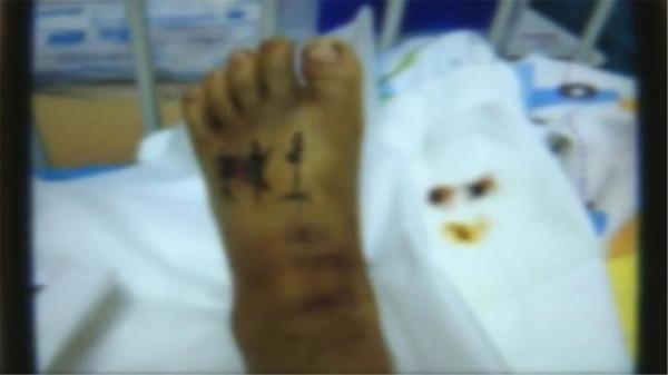  医院|惊！毒蛇溜进家，咬伤6岁孩子！这份自救常识能救命！