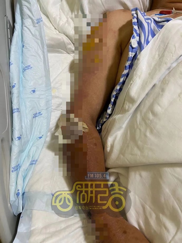  摔到|杭州大伯中午骑车外出，摔到在地半小时，就医时已浅二度烫伤！