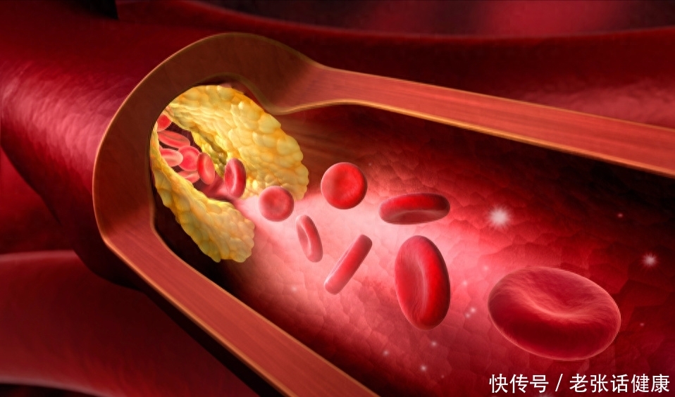 老年人怎么预防脑梗和脑血栓(提醒：5种中老年人更容易被脑梗、脑血栓盯上，希望你不在其中)